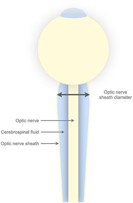 Noninvasive intracranial pressure assessment by optic nerve sheath diameter: Automated measurements as an alternative to clinician-performed measurements